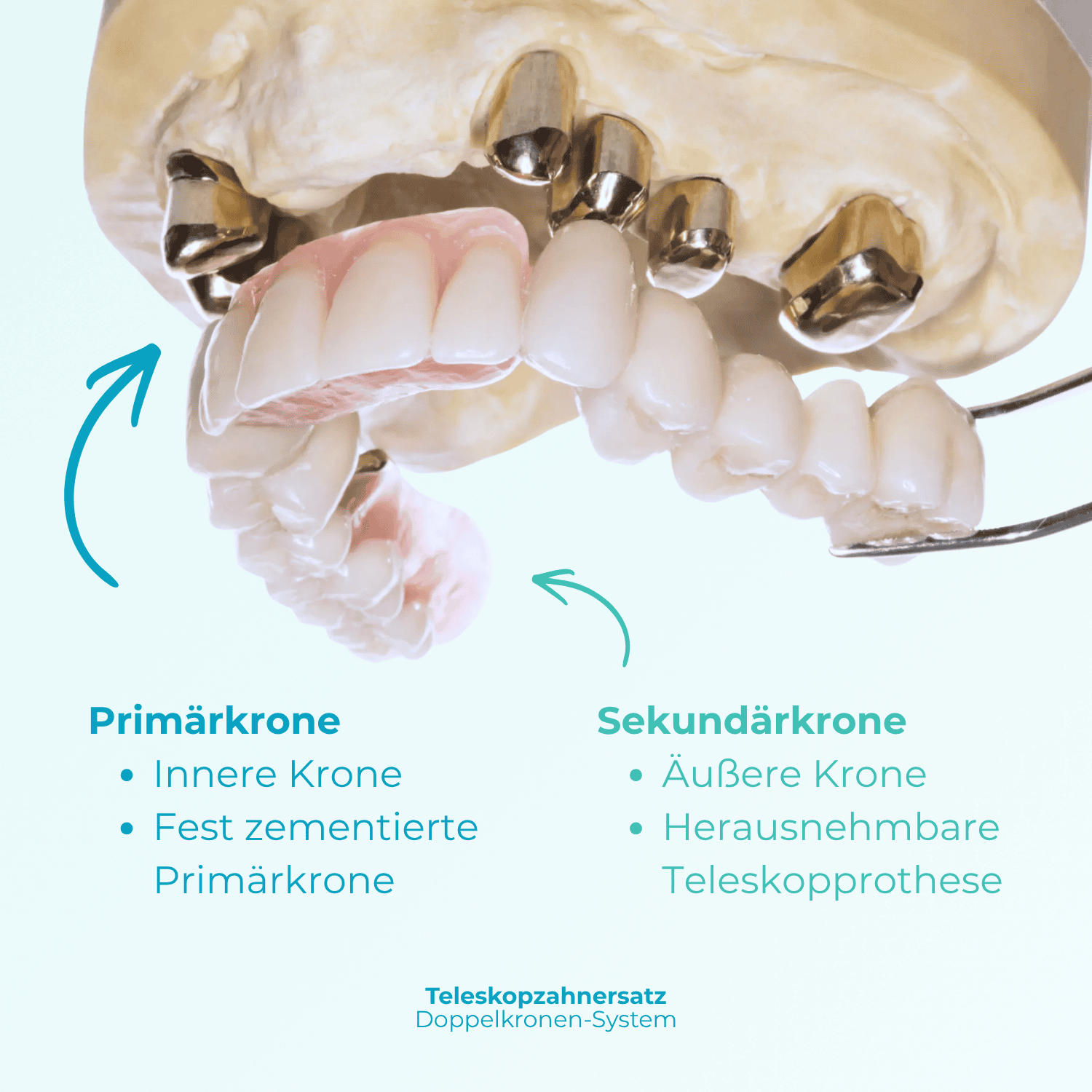 Teleskop-Zahnersatz Doppelkronen-System Dr. Jansen-Schick M&ouml;nchengladbach